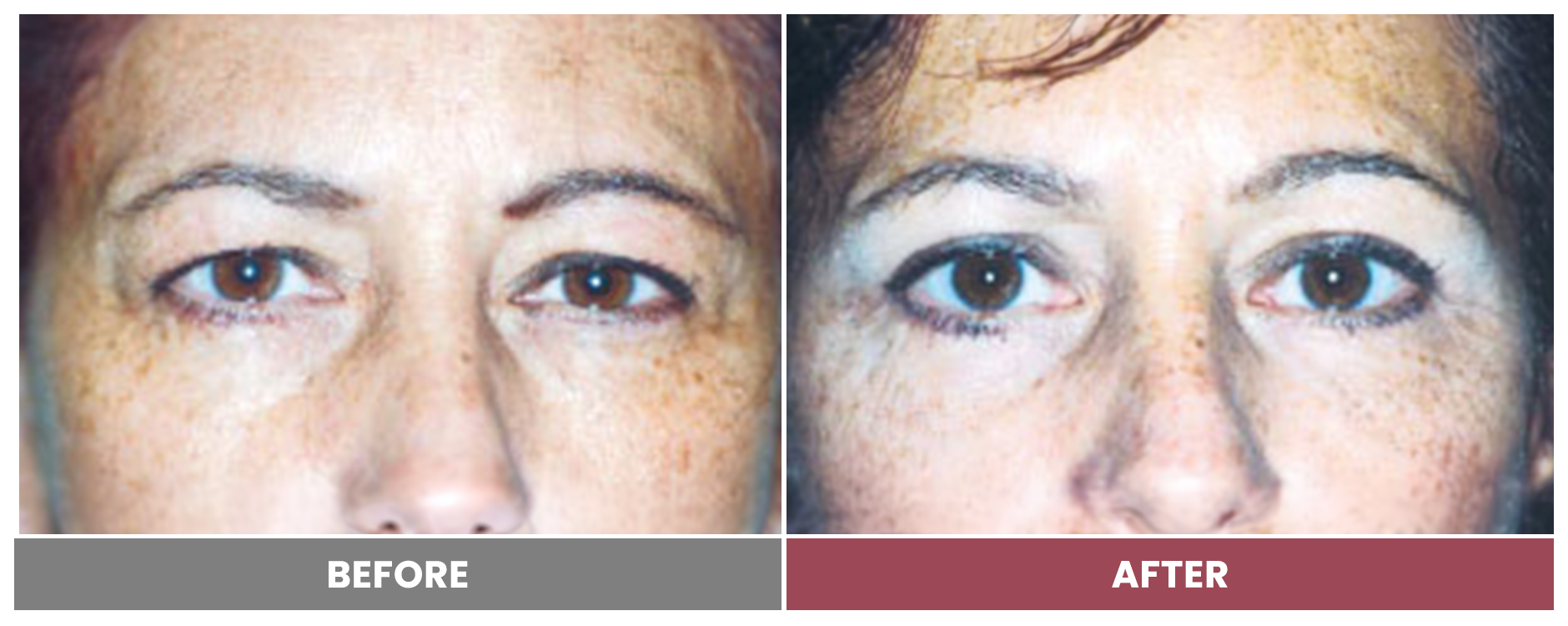 Upper Blepharoplasty - Case 84